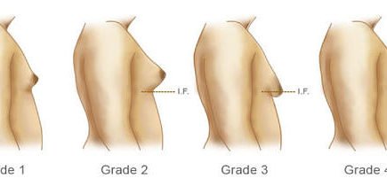 Man Boobs Analysis | Gynecomastia Solution